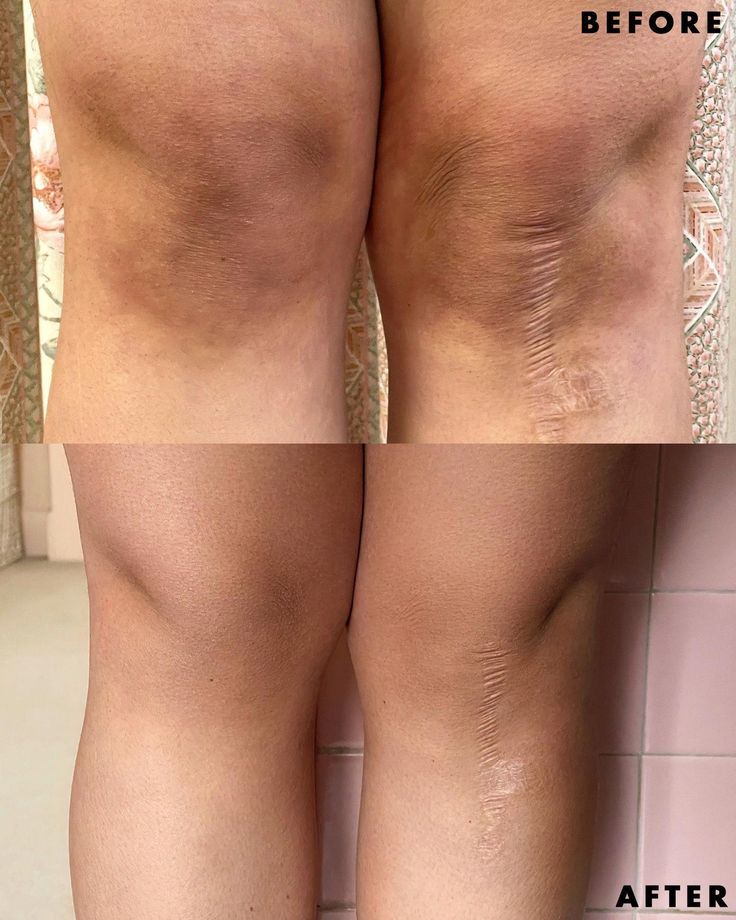 🌃🌟Glazina Charcoal Whipped - 250g Exfoliating Body Scrub For Sensitive Skin - Infused with Glycolic Acid (AHA) 🌃🌟